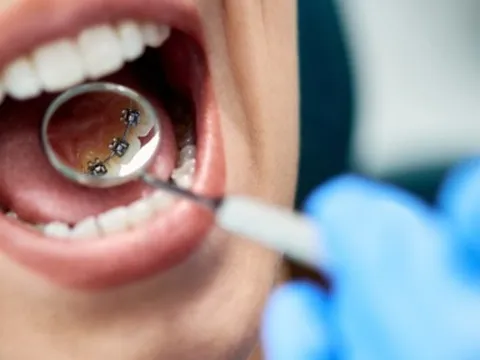 3 lý do niềng răng "mặt trong" được yêu thích