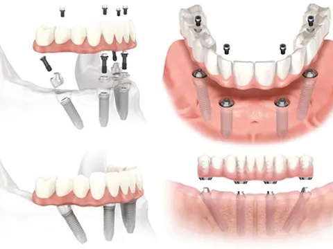 Những điều bạn cần biết về kỹ thuật cấy ghép Implant